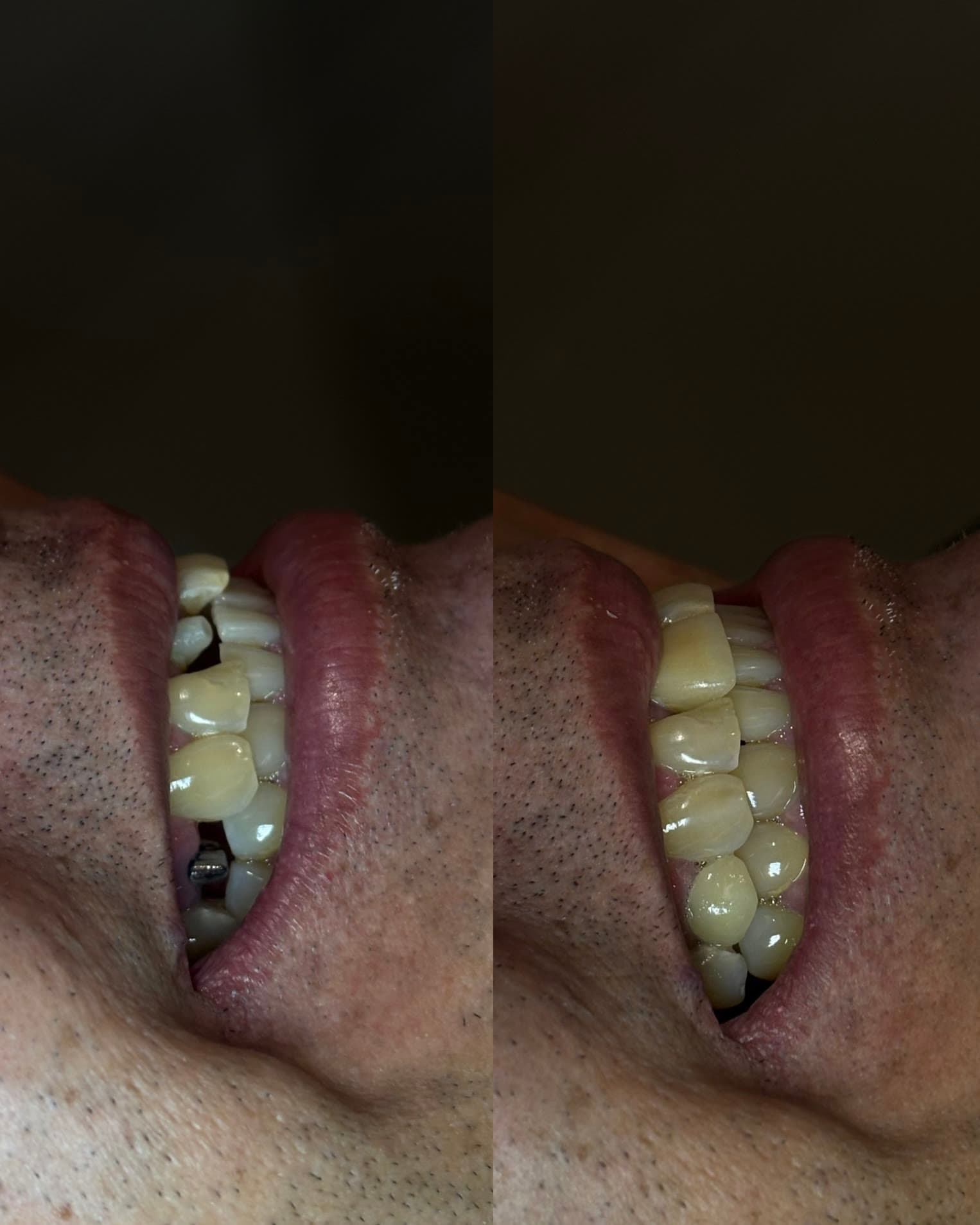 Antes e depois de coroa dentária