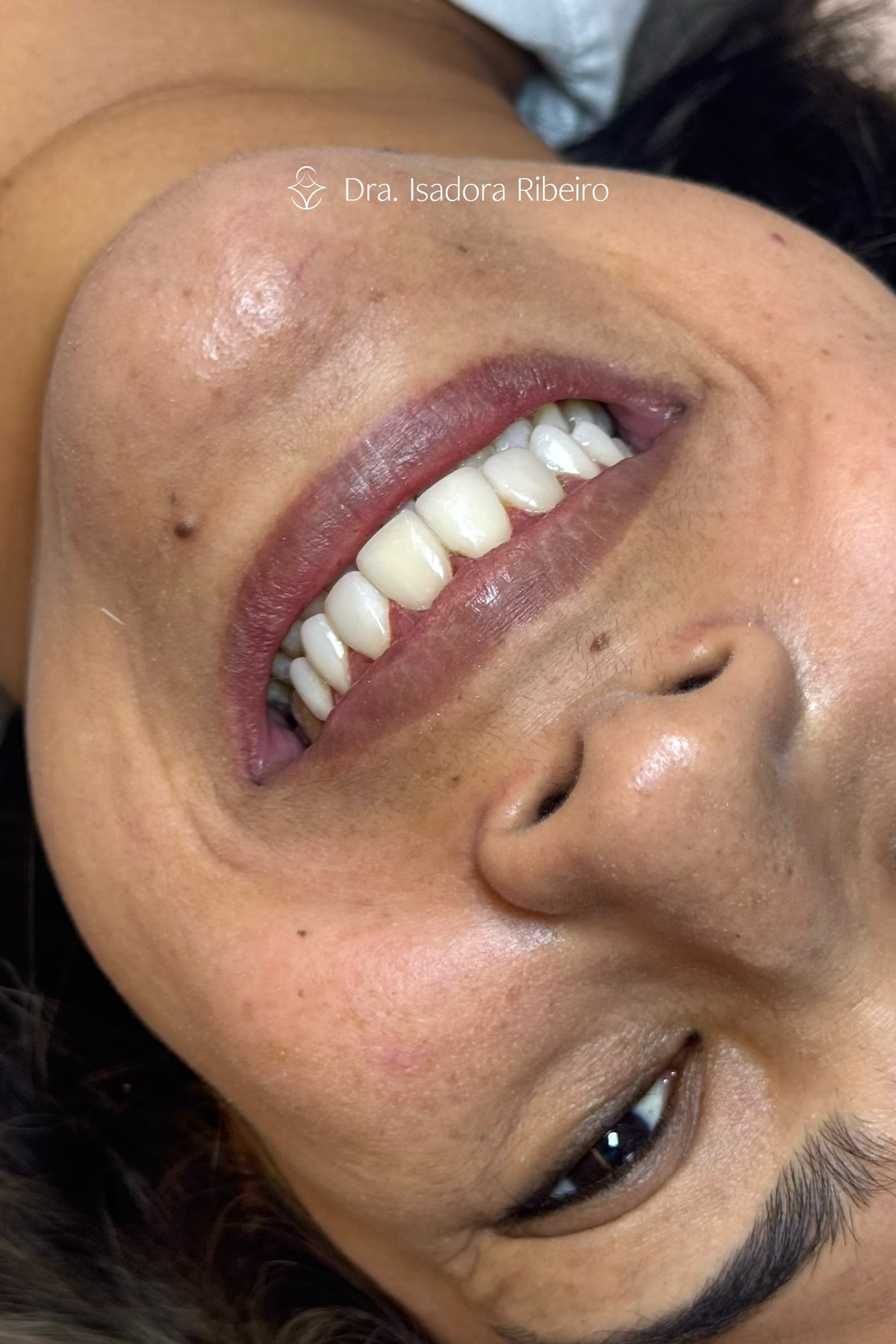 Facetas em resina