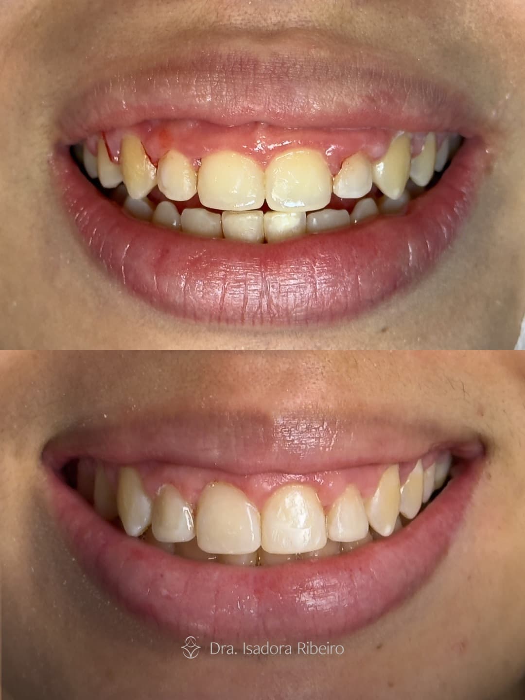 Antes e depois de gengivoplastia e recontorno estético