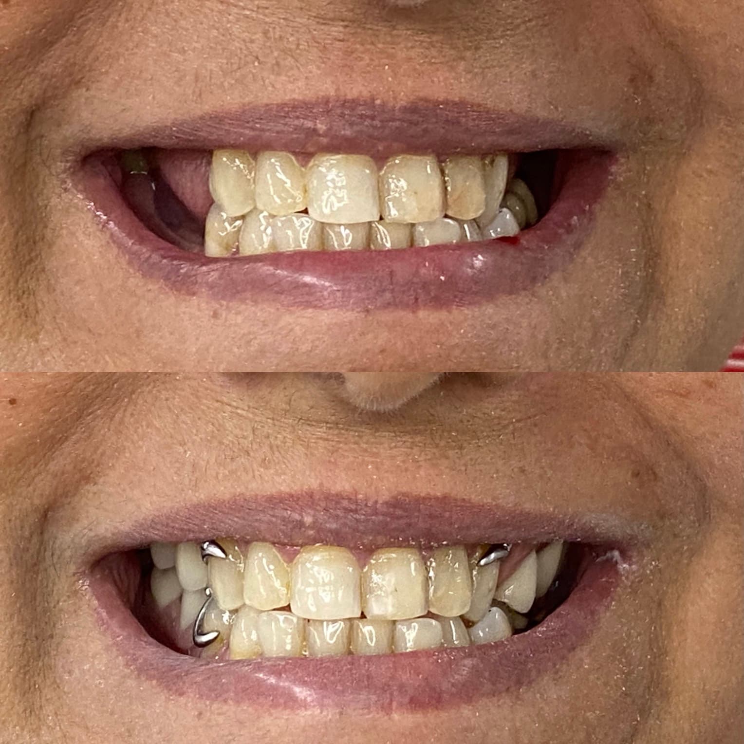 Antes e depois de prótese parcial removível