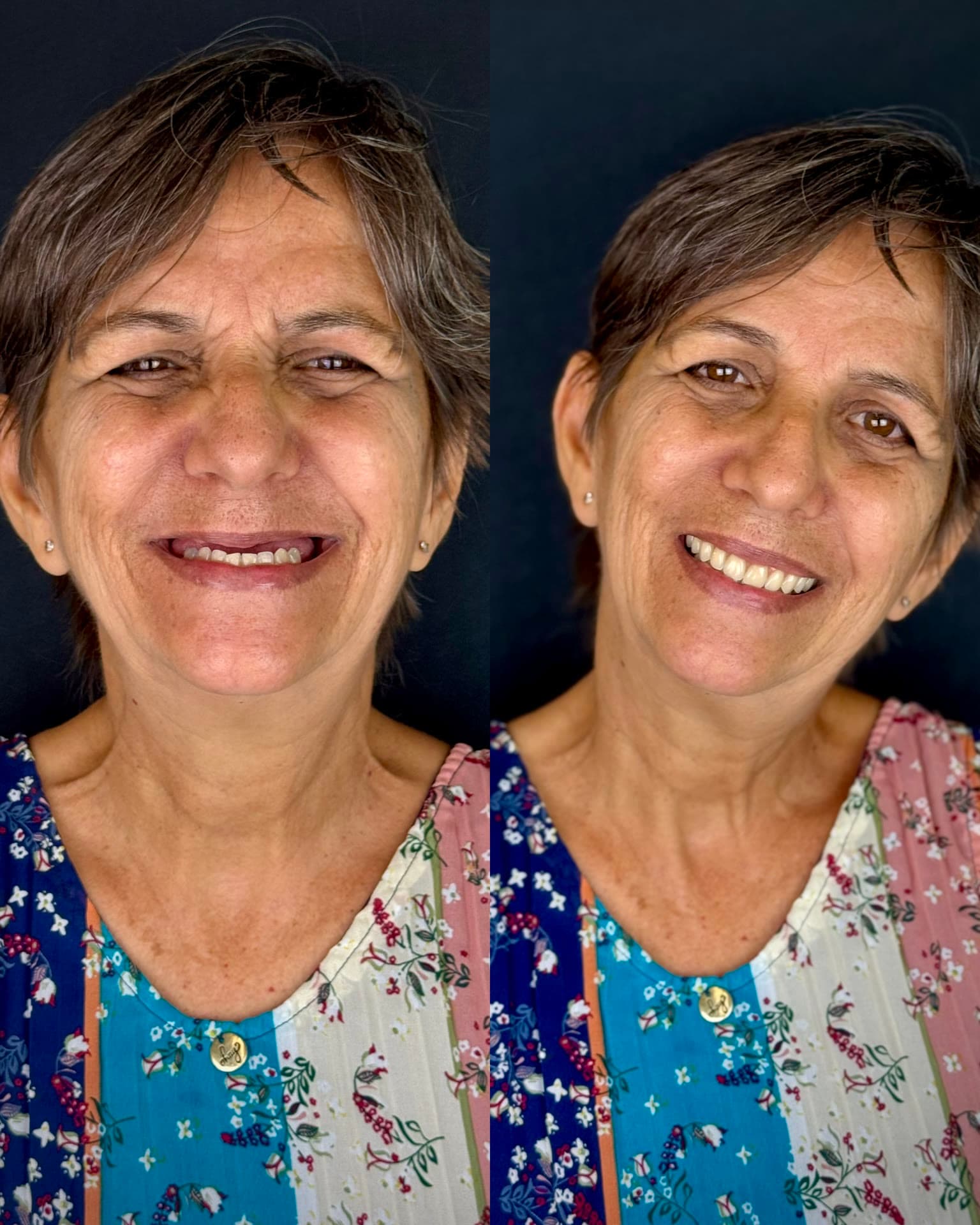 Antes e depois de prótese total